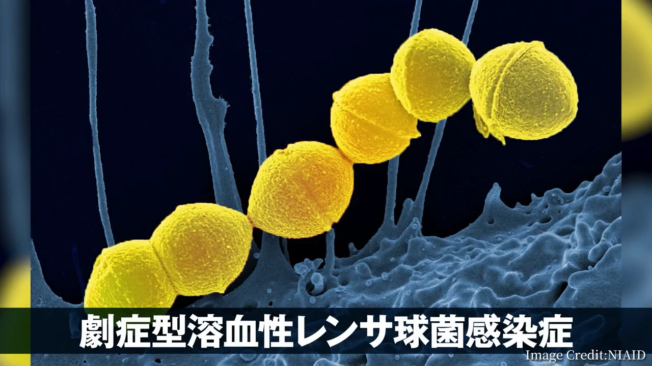 「人食いバクテリア」：身近な常在菌が牙をむくとき