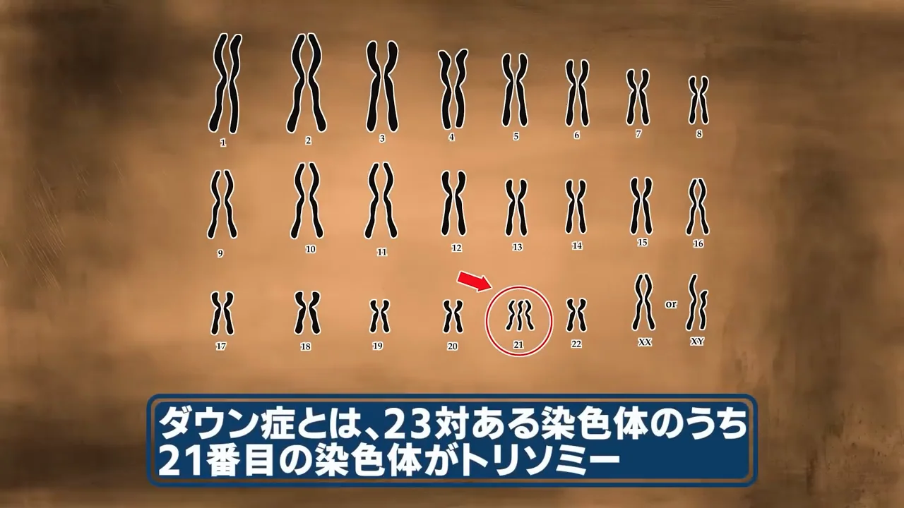 ダウン症とは何か、どう診断されるか